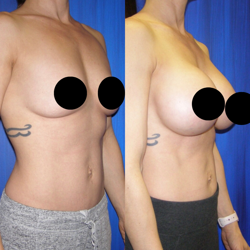 breast augmentation in miami