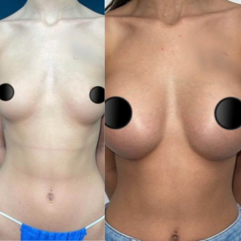 breast augmentation in miami dade