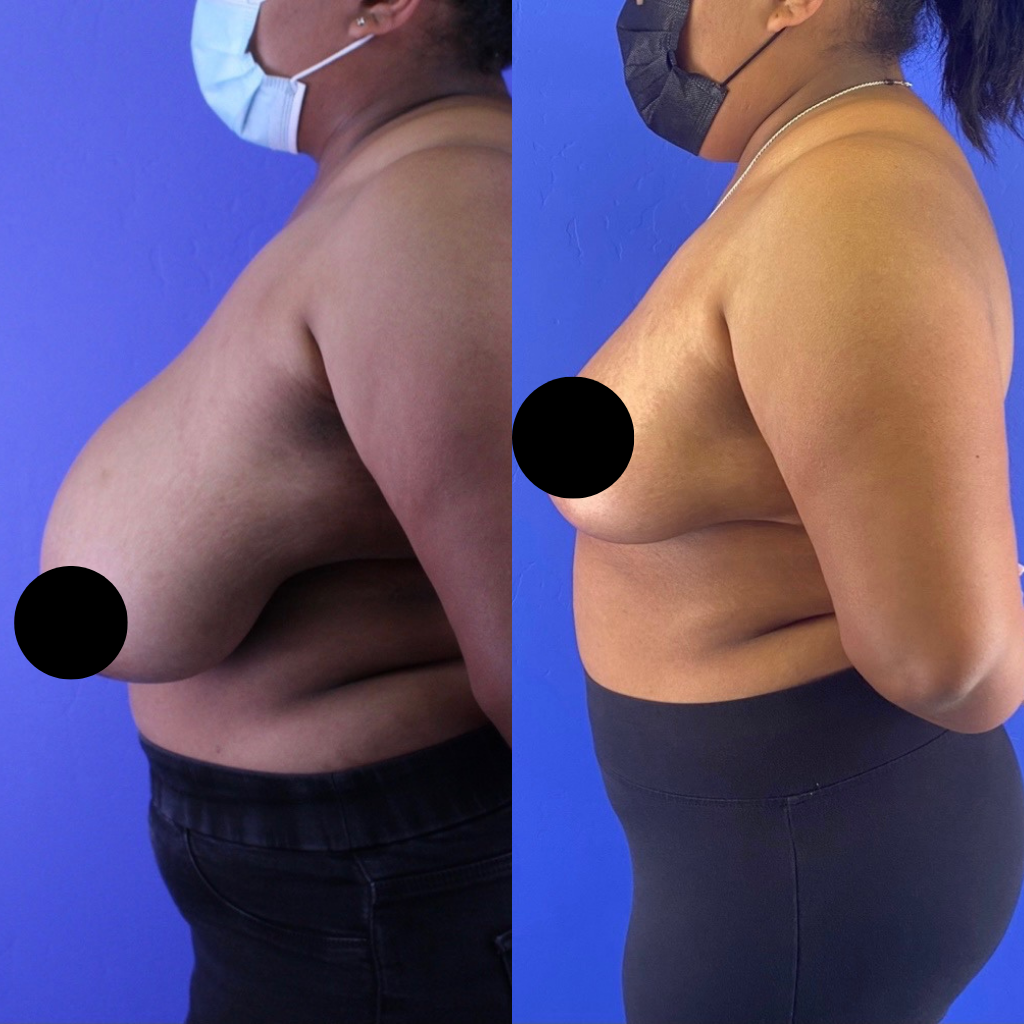 breast reduction surgery in miami