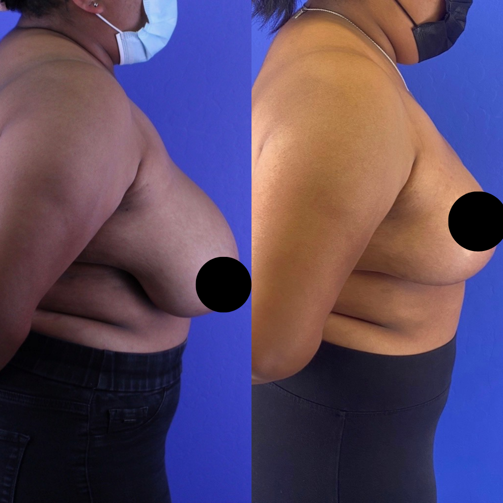 breast reduction expert in South FLorida