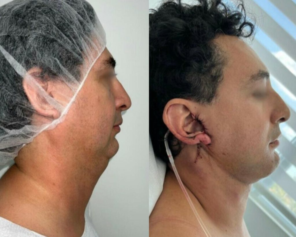 biopolymer removal sp hz 1 19 2026 31