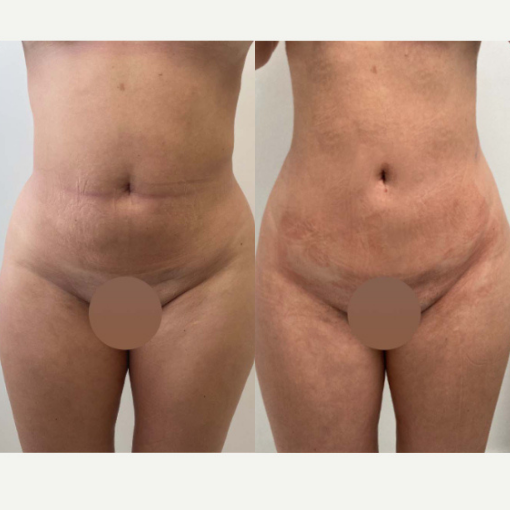 liposuction miami 1