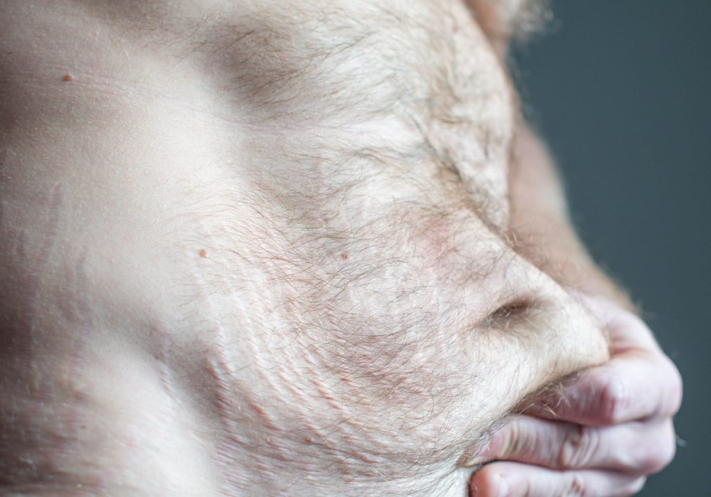 plastic surgery after major weight loss