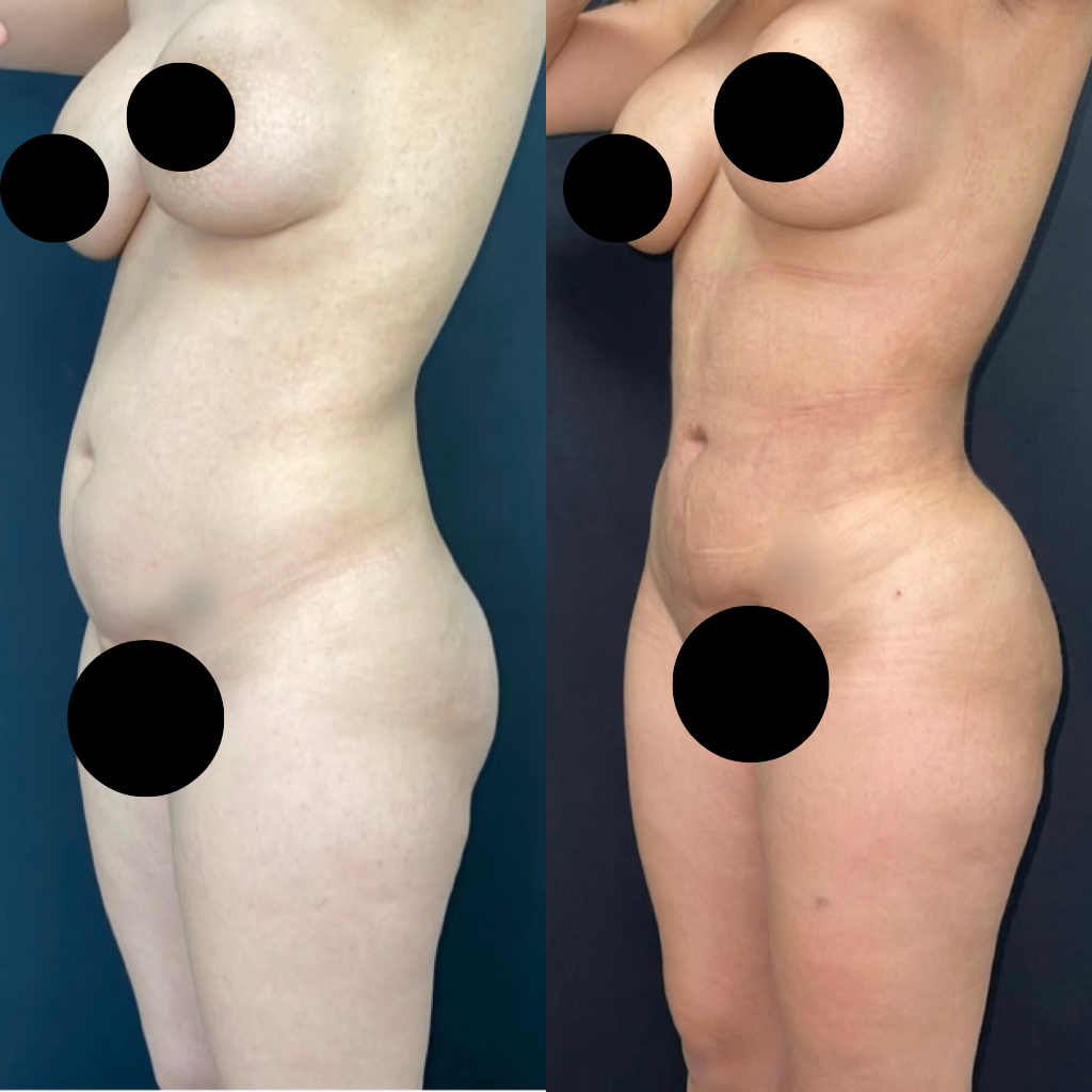 tummy tuck expert in miami