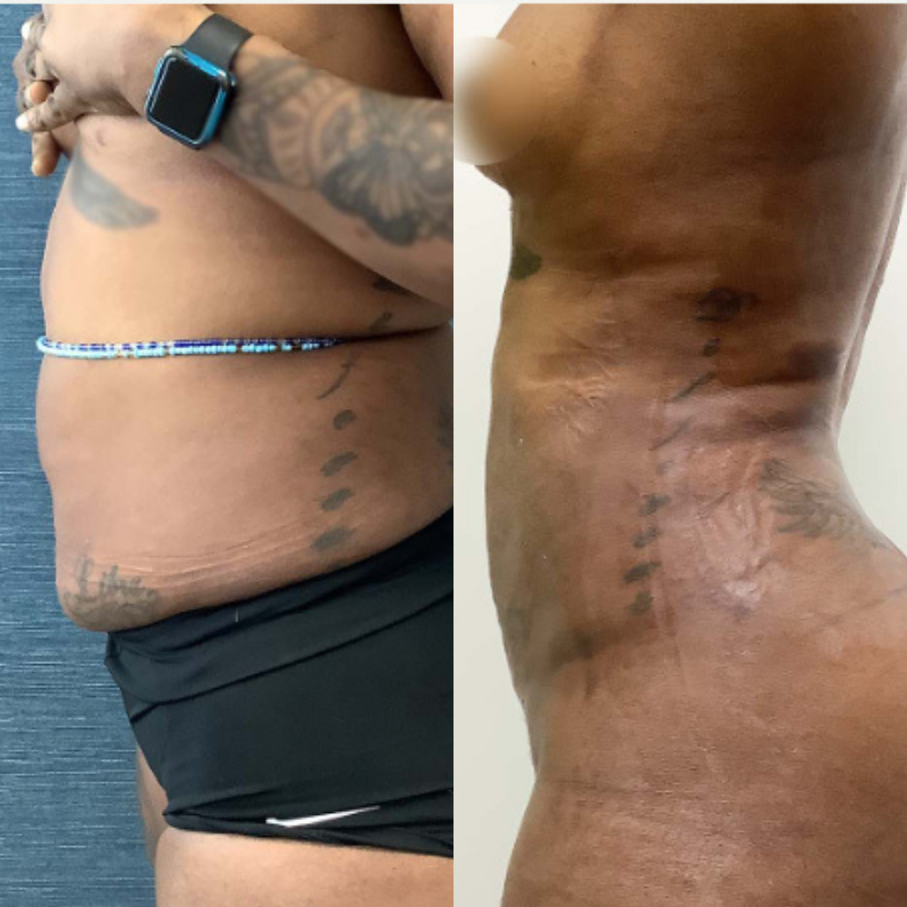 tummy tuck miami 2